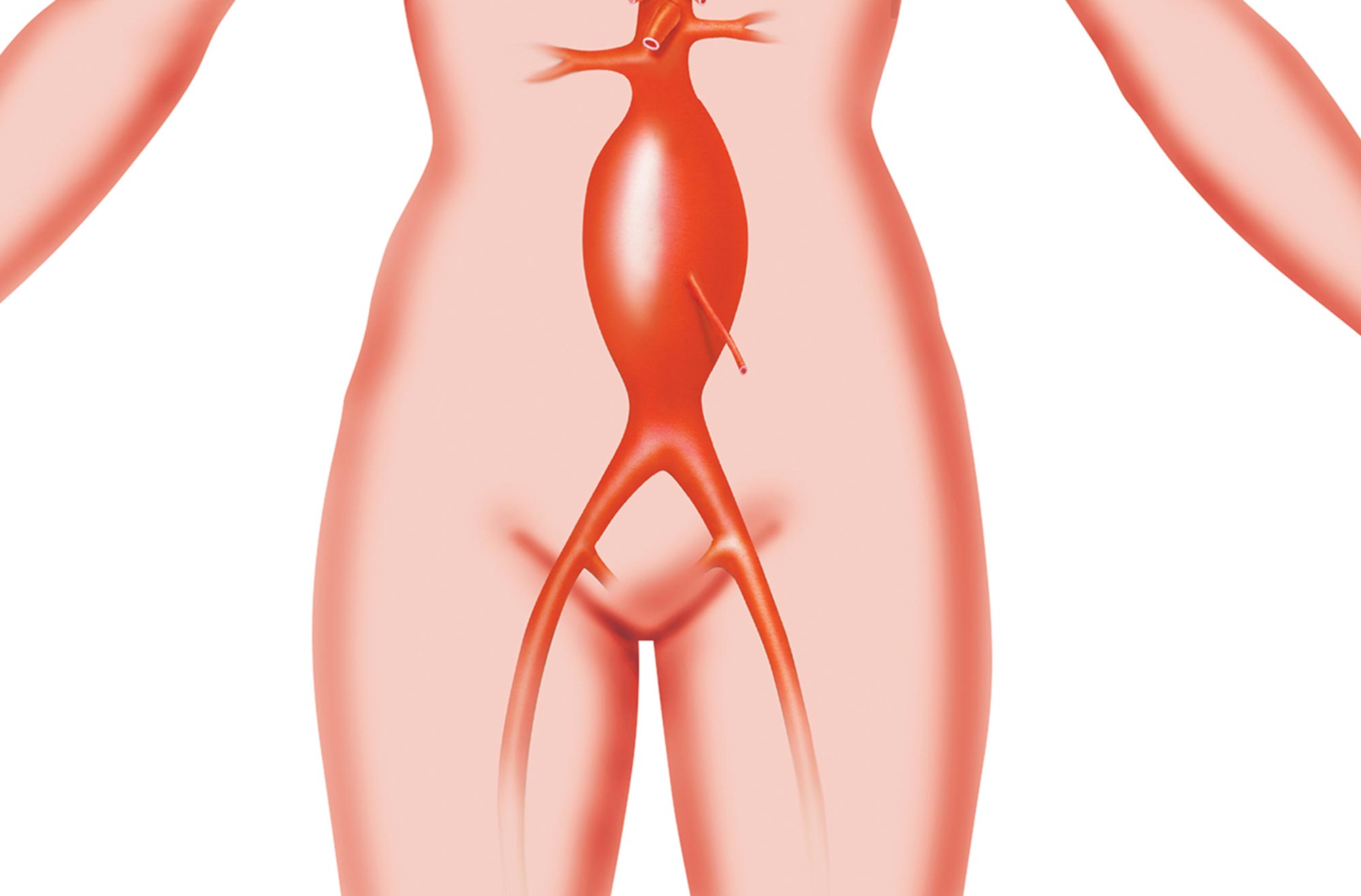 Aneurisma  dell'Aorta Addominale