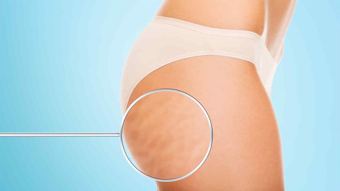 La Cellulite