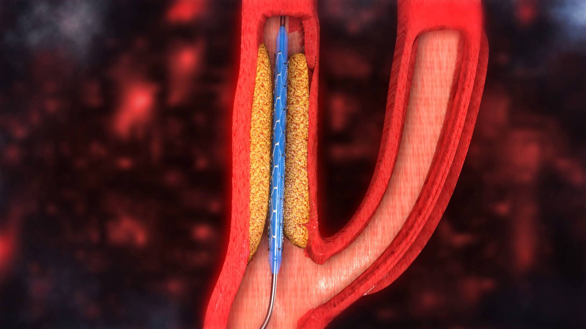 Stenosi Carotidea